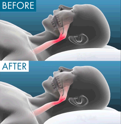 Anti-Snoring Mouthpiece - Natural Way to Sleep Better